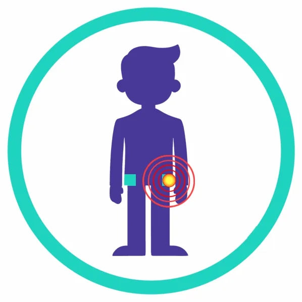 Specialist clinical icon for a hip labral tear identifying the labrum as the primary source of pain for focused shockwave treatment.